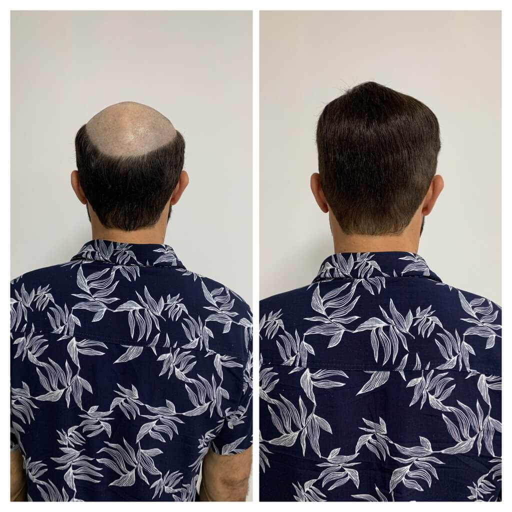 Resultado real de colocação de prótese capilar, vista de trás