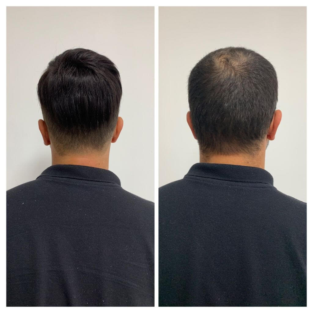 Resultado real de colocação de prótese capilar, vista de perfil