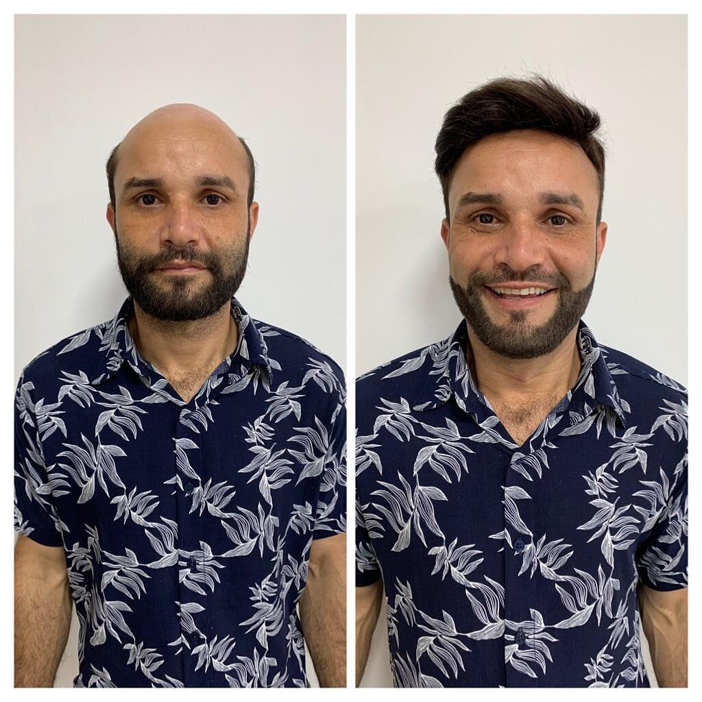 Cliente antes e depois da colocação de prótese capilar