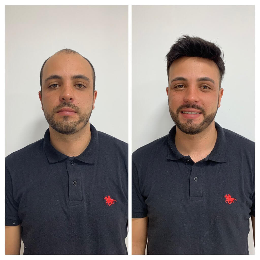 Cliente antes e depois da colocação de prótese capilar, sorrindo